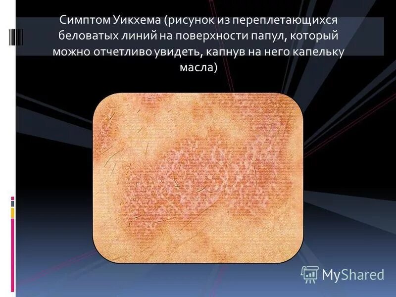 Плоский лишай на коже фото Красный плоский лишай на коже фото - ViktoriaFoto.ru