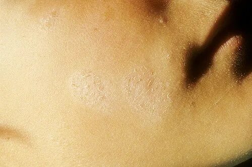 Плоский лишай на коже у человека фото Простой лишай (Pityriasis alba). Фото