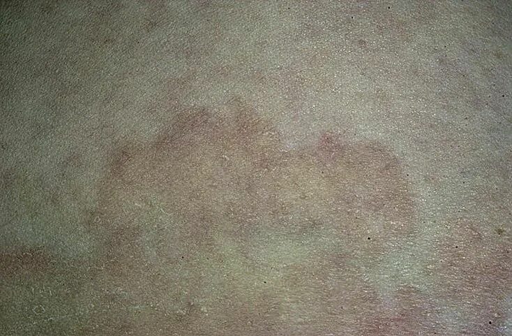 Плоский лишай на коже у человека фото Malassezia furfur и разноцветный лишай: Фотоиллюстрации Мир вокруг нас Фотогалер