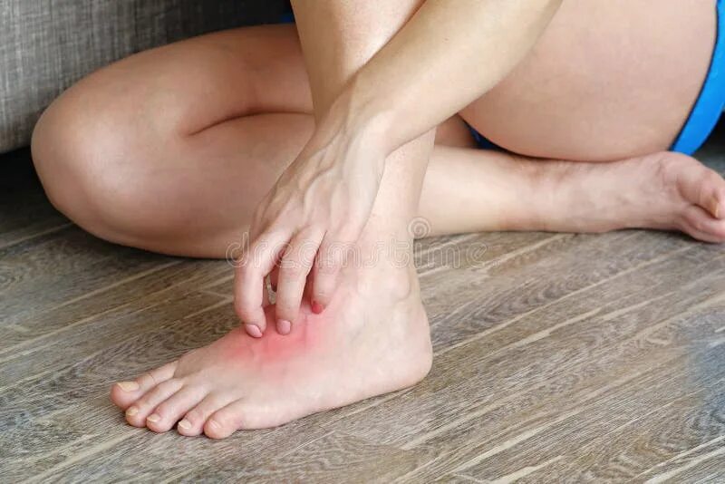 Плоский лишай на ноге фото Inflamed red spot on skin stock photo. Image of allergy - 94578598