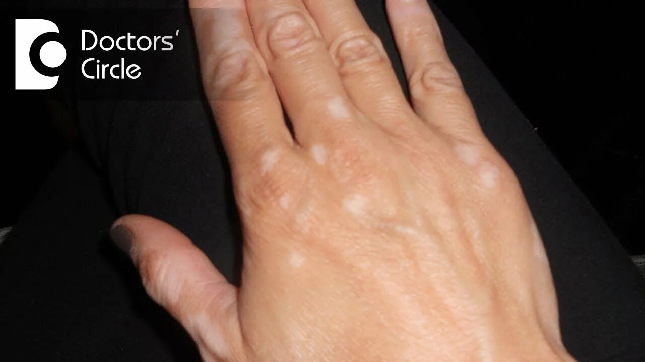 Плоский лишай на руках фото Lyrical Søndag Er velkendte white spots on skin fungus hjælpe Mars grøntsager