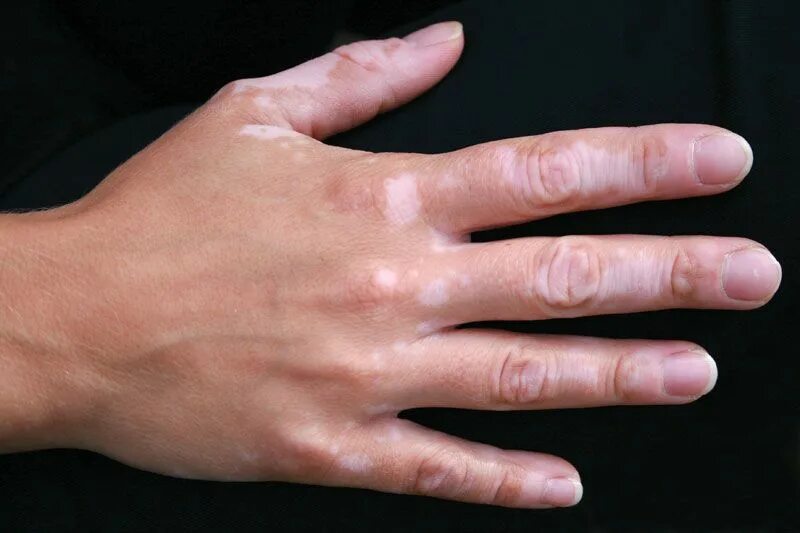 Плоский лишай на руках фото Vitiligo Definition & Facts Britannica