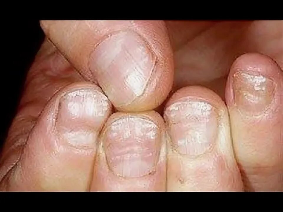 Плоский лишай ногтей фото White Stains or White Marks on your Toenails? Home Treatment Guide - YouTube