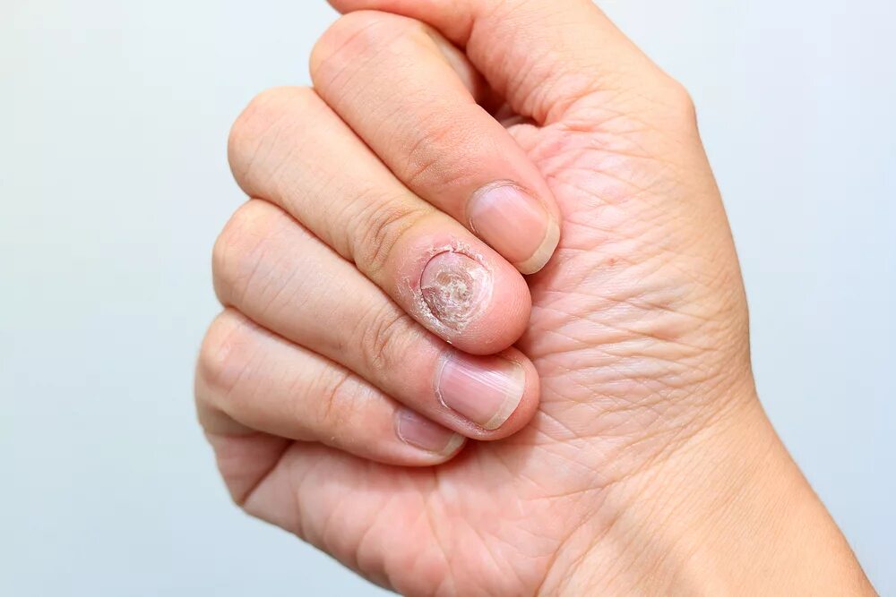 Плоский лишай ногтей фото Multiple Sclerosis Therapy Aubagio May Cause Nail Loss, Researchers Report Multi