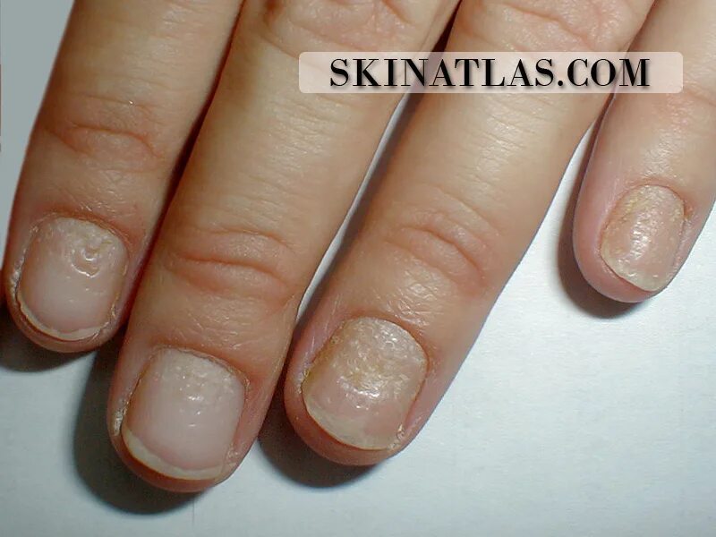 Плоский лишай ногтей фото Dr. Dubin Israeli Board Certified dermatologist - Alphabetical index of skin dis