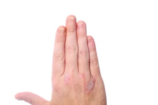 Плоский лишай ногтей фото Psoriatic arthritis patients are at a higher risk of heart problems