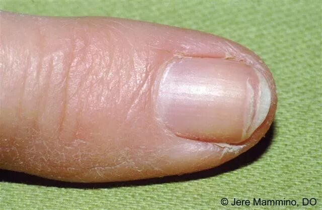 Плоский лишай ногтей фото Brittle Splitting Nails - American Osteopathic College of Dermatology (AOCD) Nai