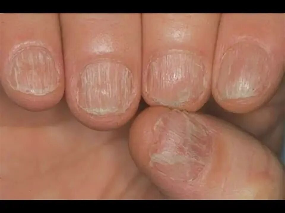 Плоский лишай ногтей фото Causa y Solucion en lineas en las uñas - YouTube