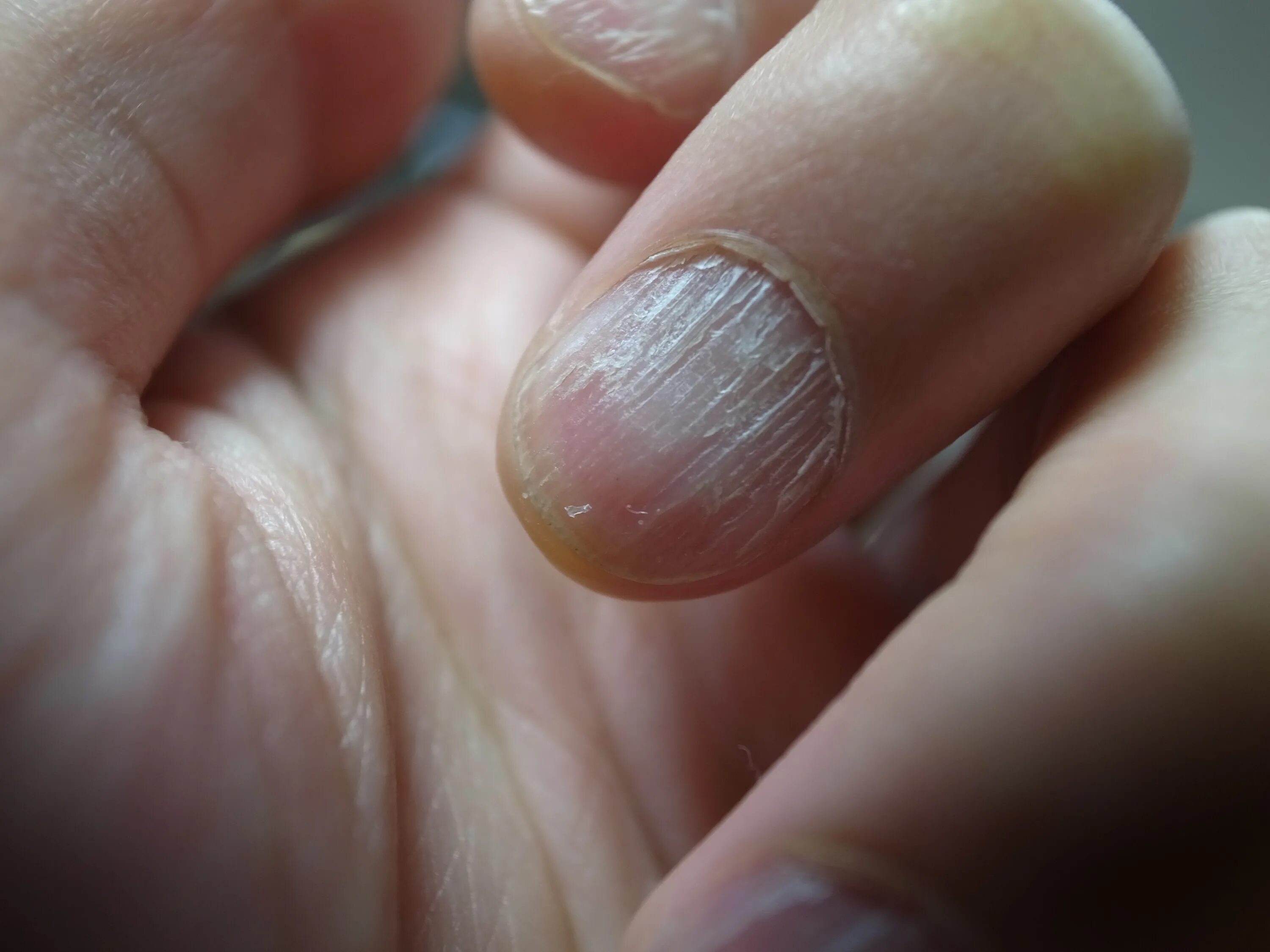 Плоский лишай ногтей фото Hair Like Pieces Of Skin Around Fingernails Best Sale www.beztabaka.by