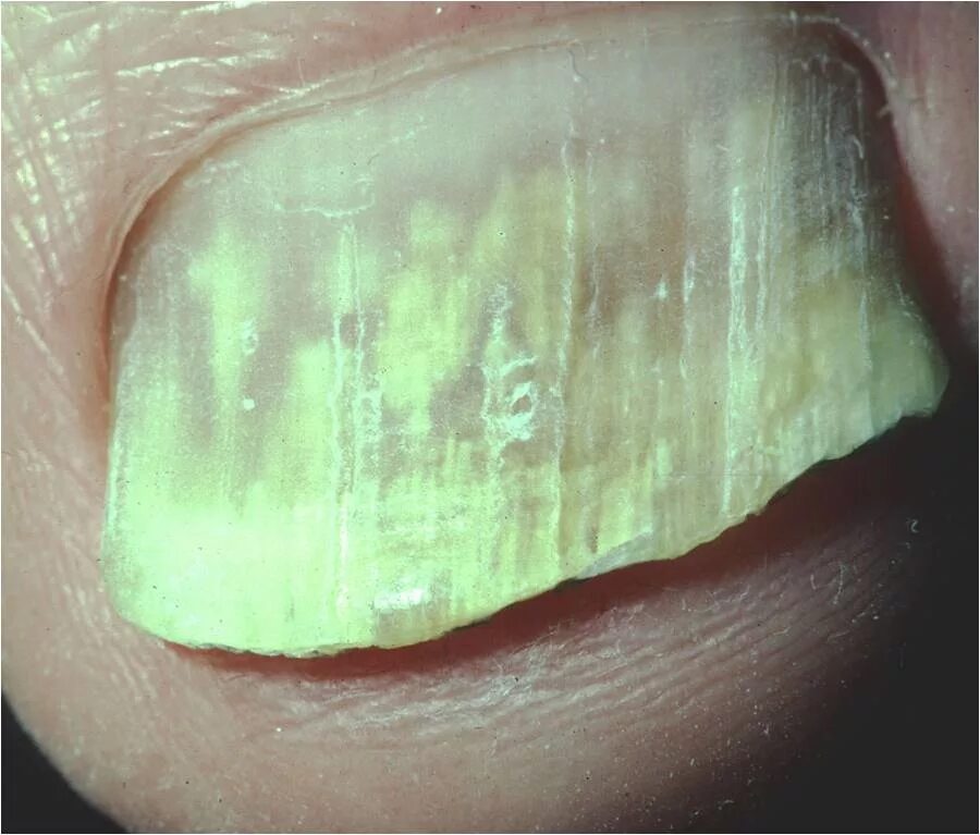 Плоский лишай ногтей фото Onychomycosis (Tinea unguium, Nail fungal infection) - Cancer Therapy Advisor