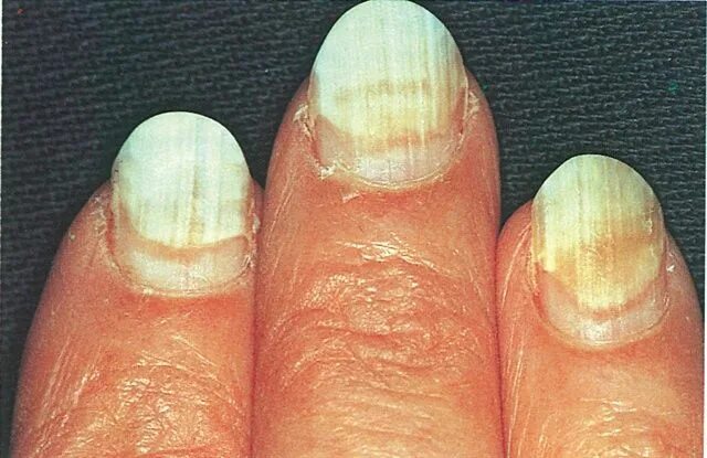 Плоский лишай ногтей фото When Nails Separate Nail problems, Nails magazine, Brittle nails