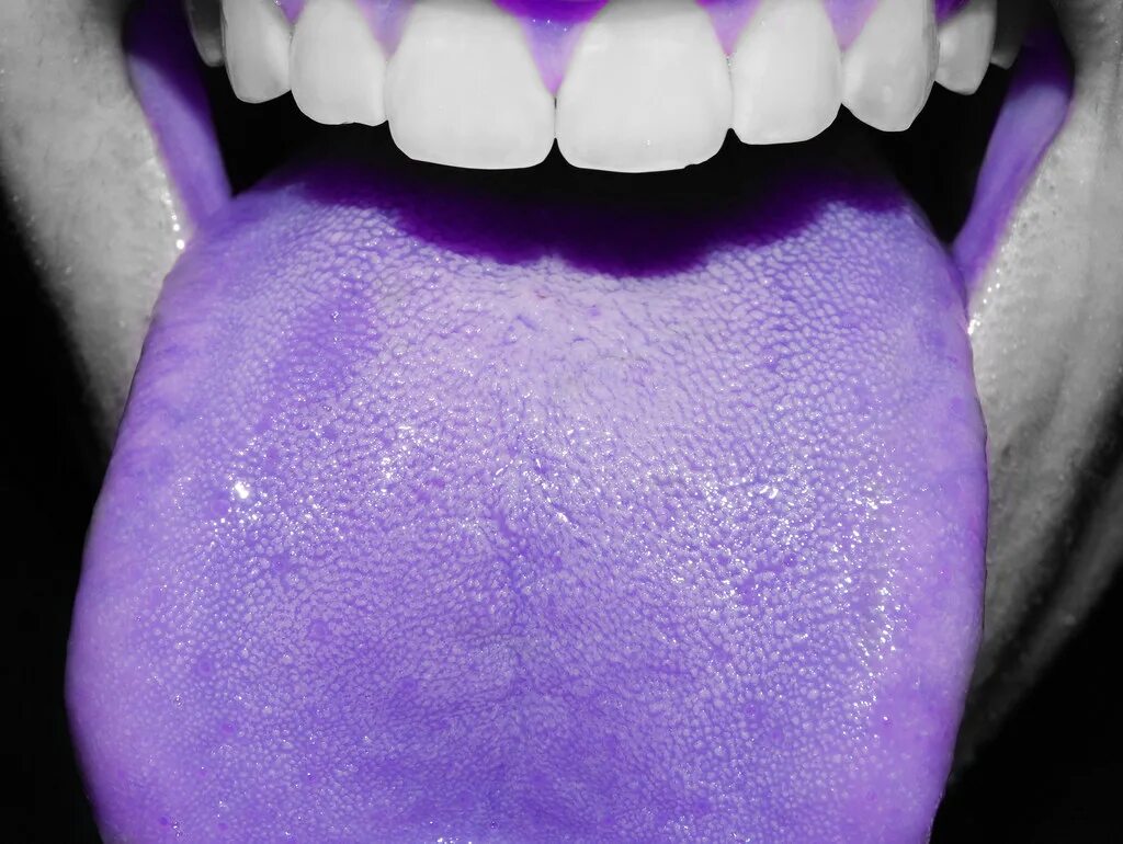 Плоский лишай полости рта фото purple tongue jordan 5 - Shop The Best Discounts Online OFF 69
