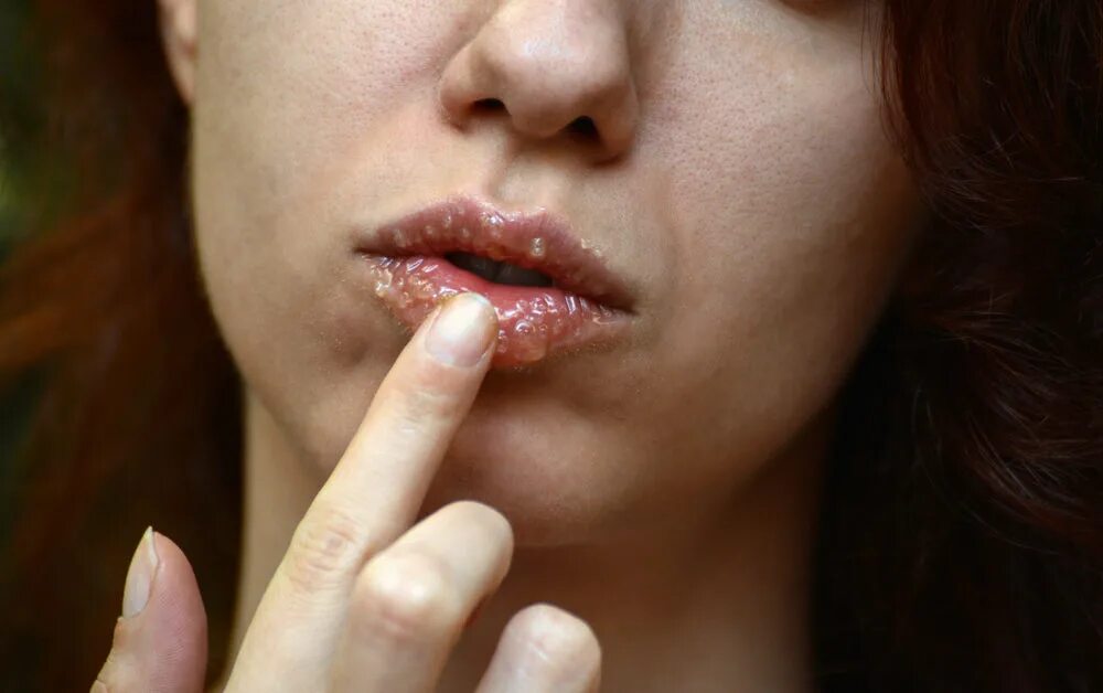 Плоский лишай полости рта фото Lip Lines: 13 Best Treatments for Lip Wrinkles Colorescience