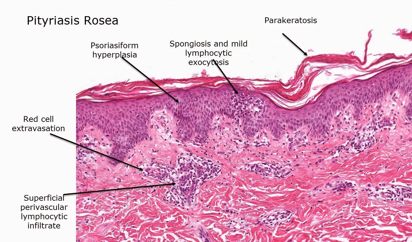 Плоский лишай вульвы фото Dermatopathology Made Simple - Inflammatory: Psoriasiform Reaction Pattern