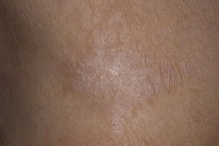 Плоский лишай вульвы фото Грибок на коже: симптомы, лечение и профилактика кожных микозов best-facebook.ru