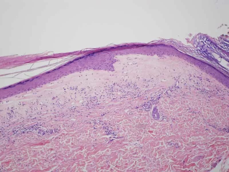 Плоский лишай вульвы фото Lichen Sclerosus et Atrophicus (lichen sclerosus preferred term, lichen planus a