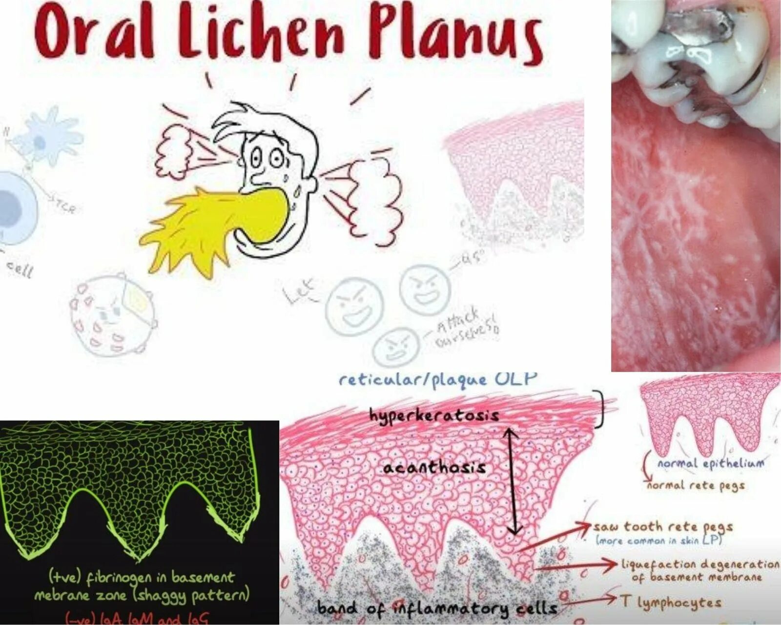 Плоский лишай вульвы фото Salivary Cytokines :Effective And Effortless Diagnosis Of Oral Lichen Planus - K