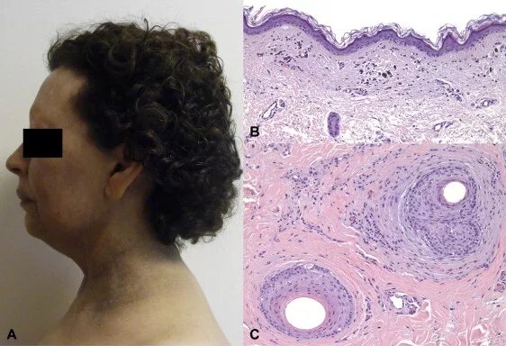 Плоский лишай вульвы фото A, Lichen planus pigmentosus and frontal fibrosing alopecia. Diffuse... Download