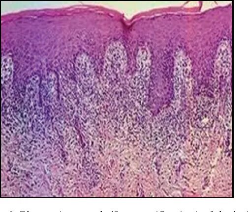 Плоский лишай вульвы фото Figure 2 from Ulcerative Lichen Planus in Childhood Semantic Scholar