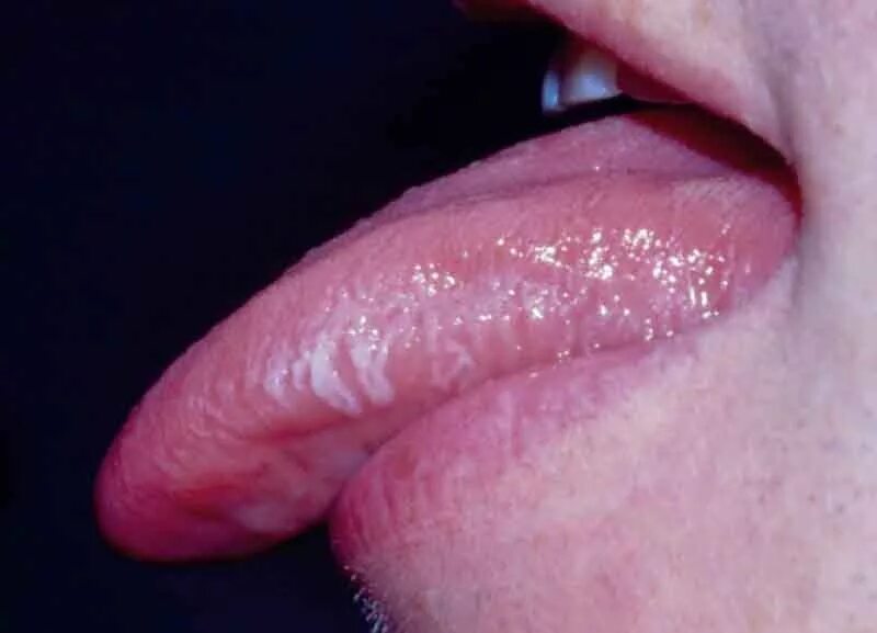 Плоский лишай языка фото Question 1 - Oral Manifestations Question Bank - National HIV Curriculum