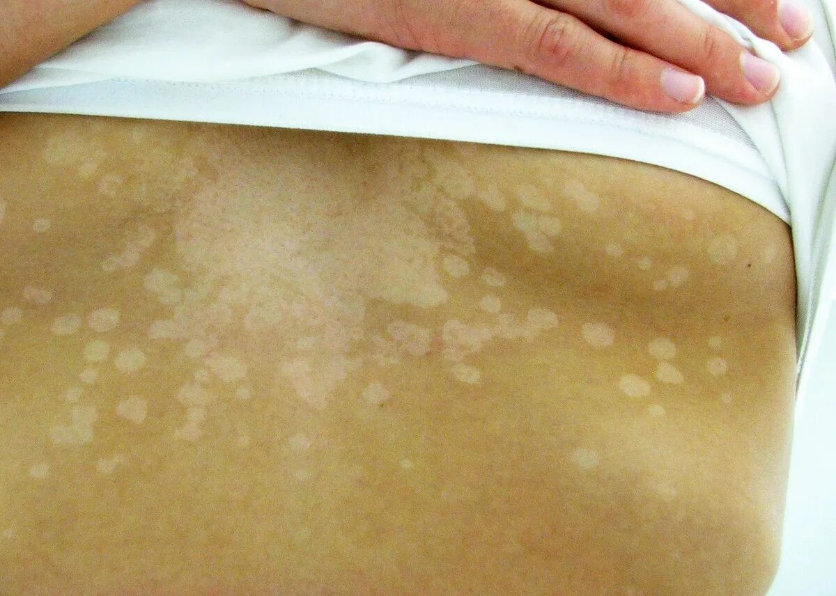Плоский лишай языка фото Tinea versicolor - Wikipedia