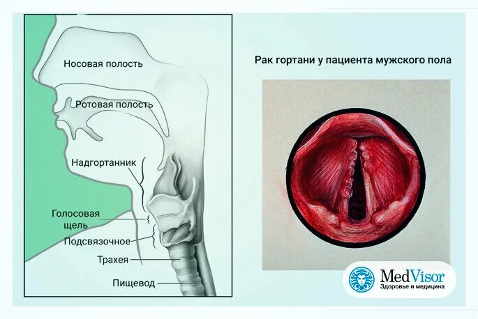 Плоский рак горла фото Какие симптомы у рака горла (гортани) medvisor.ru Дзен
