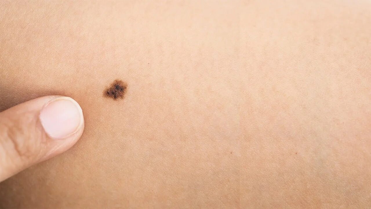 Плоский рак кожи фото начальная стадия El Secreto Astrológico y Cabalístico de los Lunares y Manchas del Cuerpo / 5781 