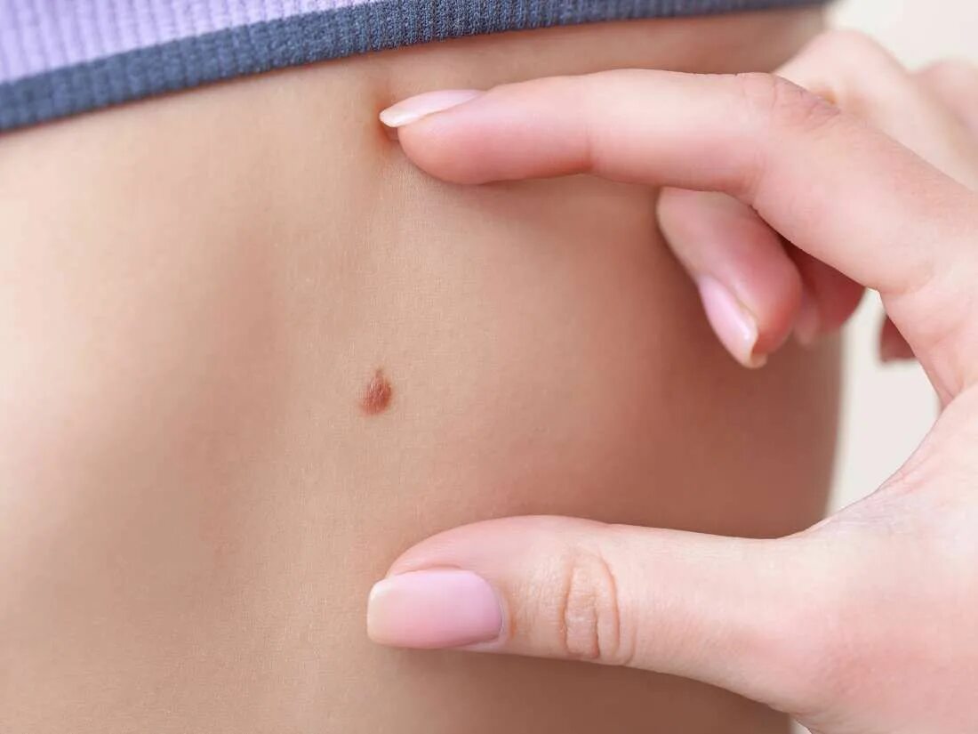 Плоский рак кожи фото начальная стадия #Melanoma: More evidence that antioxidants speed up tumor spread breaking medica
