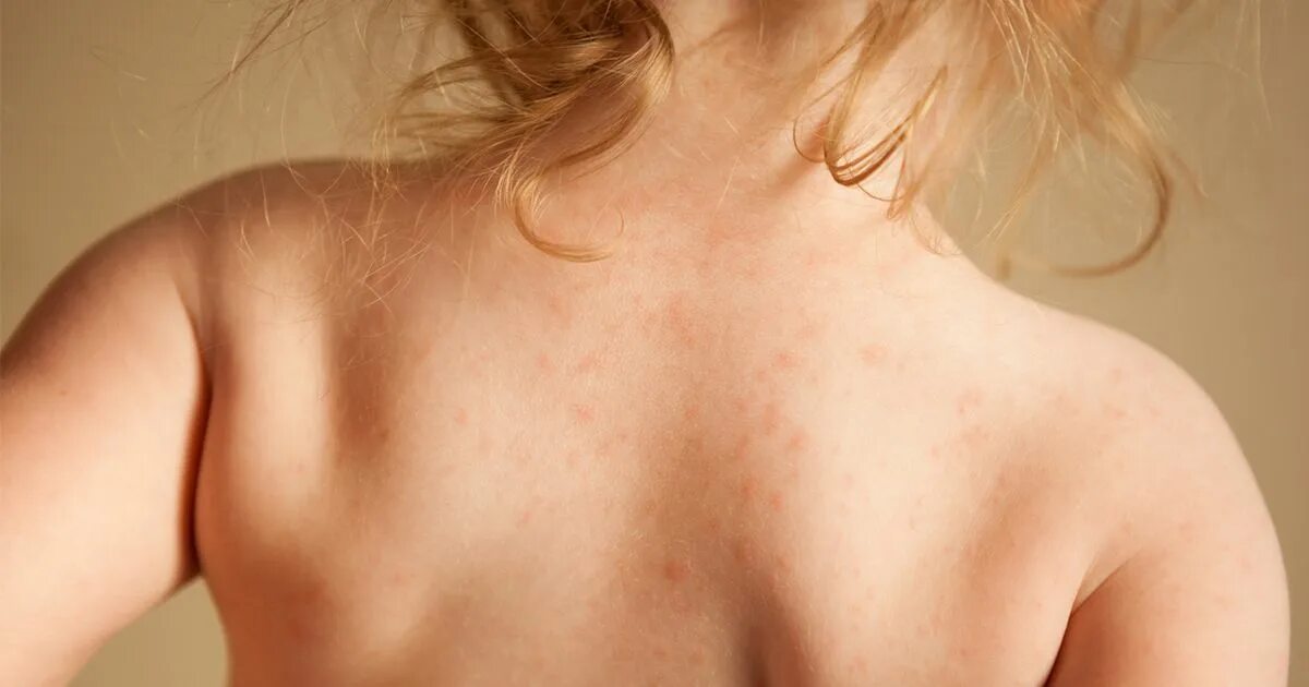 Плоский розовый лишай фото Food allergy symptoms FAQ: How to tell if your kid has a food allergy - Today's 