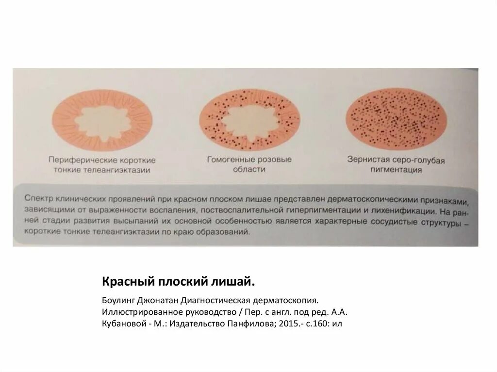 Плоский розовый лишай фото и лечение Стригущий лишай у детей: о формах и лечении рассказывает опытный педиатр