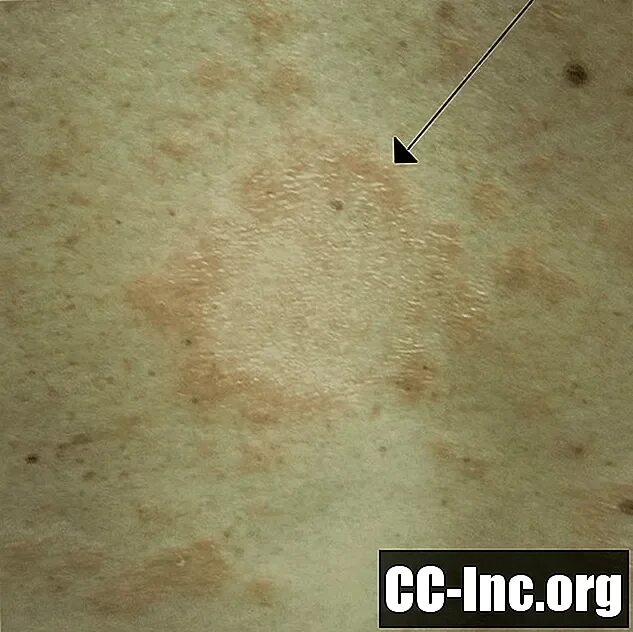 Плоский розовый лишай фото и лечение Cara Mengenali Ruam Pityriasis Rosea - Obat - 2024