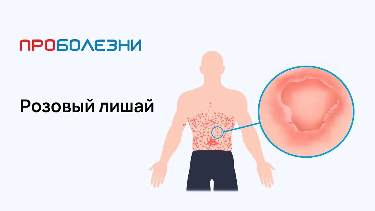 Плоский розовый лишай фото и лечение Розовый лишай - YouTube