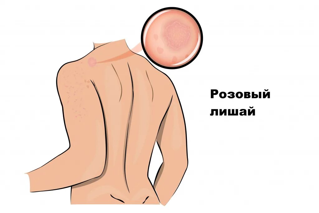 Плоский розовый лишай фото и лечение Розовый лишай - причины появления, симптомы заболевания, диагностика и способы л