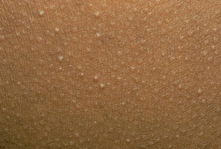 Плоский волосяной лишай на голове фото The Fastest Ways to Get Rid Of Zits, Ingrown Hairs, and 5 Other Annoying Skin Pr