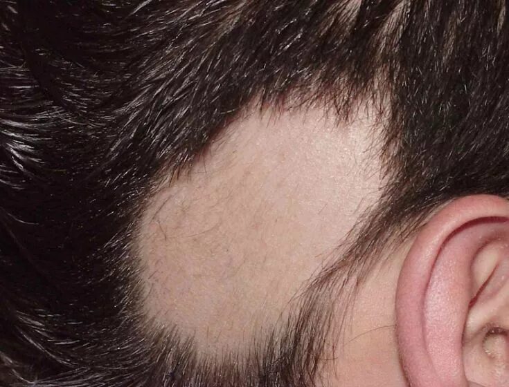 Плоский волосяной лишай на голове фото TRICOLOGÍA: ANATOMÍA, TIPOS DE CABELLO, CUERO CABELLUDO, ALOPECIAS E INFECCIONES