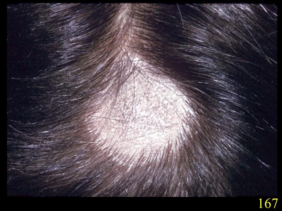 Плоский волосяной лишай на голове фото Microsporum canis A zoophilic dermatophyte, which is a frequent cause of ringwor