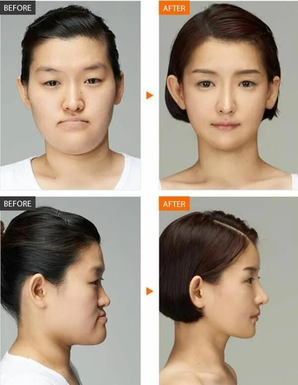 Плоское лицо фото Amazeball !!!! korean plastic surgery before after BOOK Consuming Fire - A Plast
