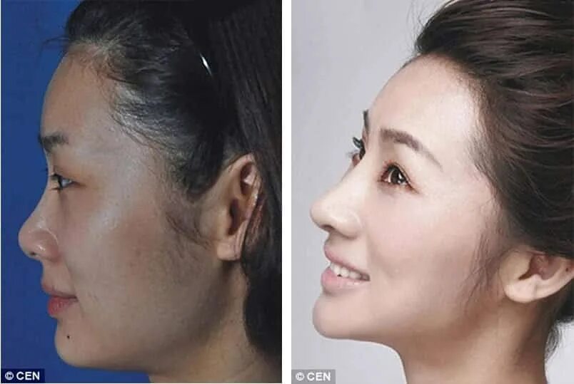 Плоское лицо фото 52 Plastic Surgery Photos In Korea That Prove Miracles Exist - Elite Readers
