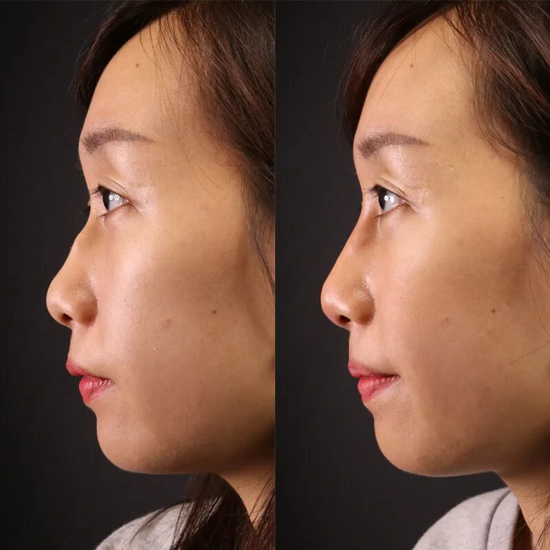 Плоское лицо фото Contour Clinics - A refined nose bridge and elevated tip, refined contour - univ