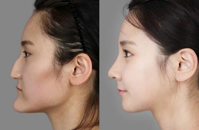 Плоское лицо фото ส ด ท ง! ร ว ม ภ า พ ก อ น-ห ล ง ศ ล ย ก ร ร ม เ ก า ห ล