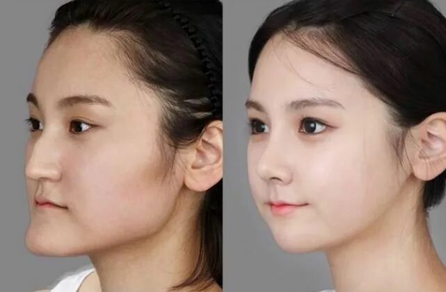 Плоское лицо фото Khớp cắn ngược là gì ? Cách điều trị AN TOÀN và HIỆU QUẢ nhất Surgery, Chin redu