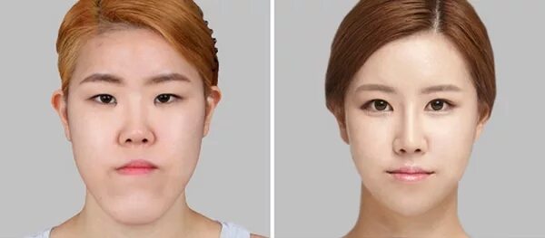 Плоское лицо фото Как меняются четы лица после лечения брекетами
