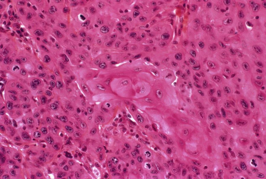 Плоскоклеточный рак фото начальная стадия Skin Cancer #1 Photograph by Cnri/science Photo Library - Fine Art America