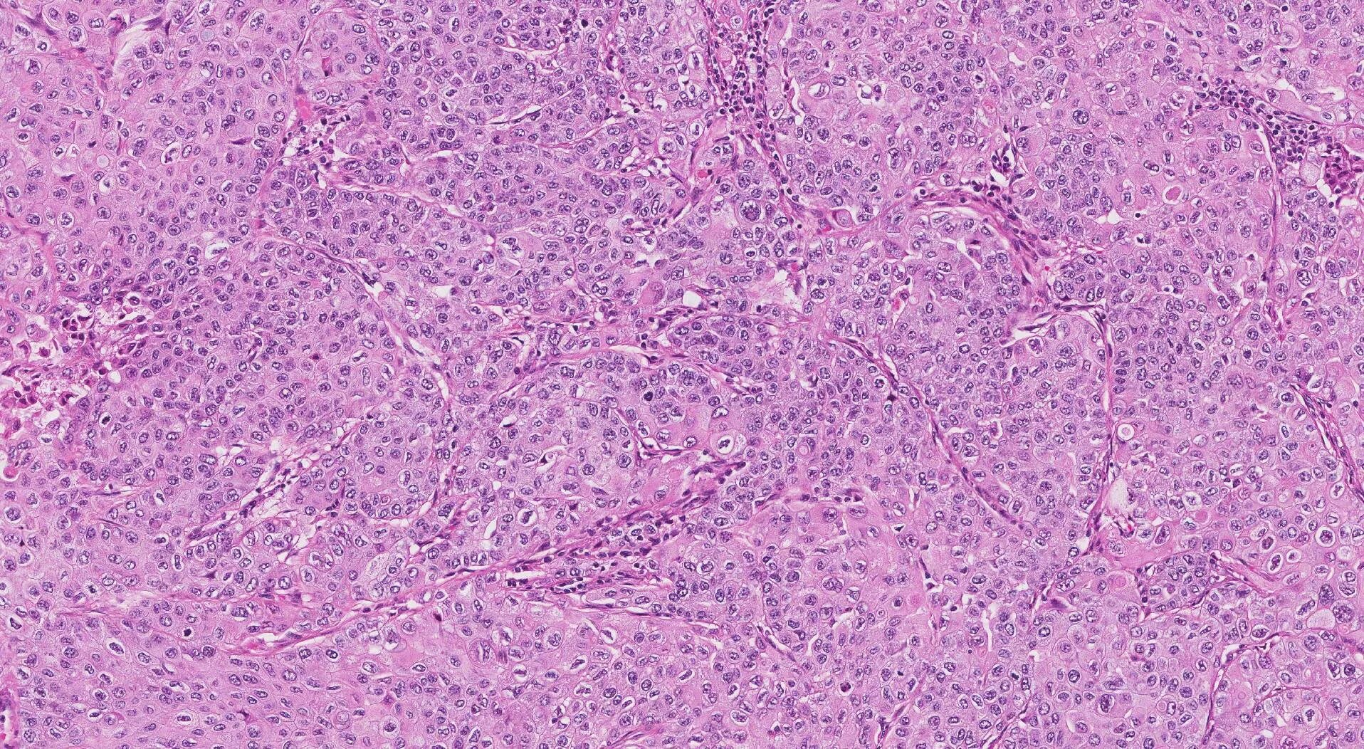 Плоскоклеточный рак фото начальная стадия Squamous cell carcinoma of the lung MyPathologyReport.ca