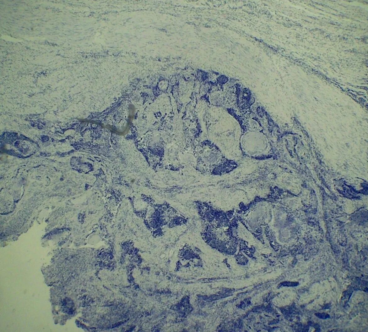 Плоскоклеточный рак фото начальная стадия Файл:Squamous cell carcinoma (medium differentiated).jpg - Вікіпедія
