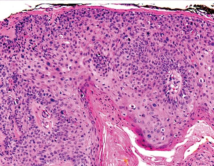 Плоскоклеточный рак фото начальная стадия Cutaneous squamous-cell carcinoma - Wikipedia
