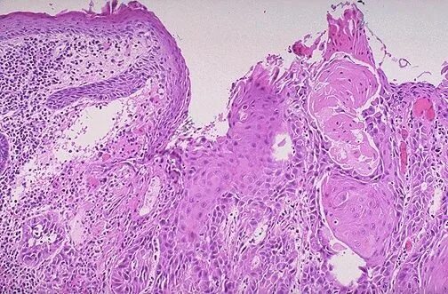 Плоскоклеточный рак фото начальная стадия Squamous cell, Esophageal cancer, Science and nature