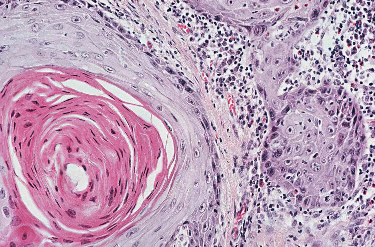 Плоскоклеточный рак фото начальная стадия Tumor Markers: Definition and Examples