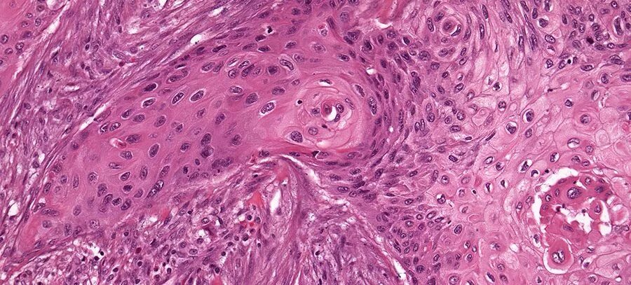 Плоскоклеточный рак фото начальная стадия Surplus of antioxidants increases probability of emergence of metastasises of a 