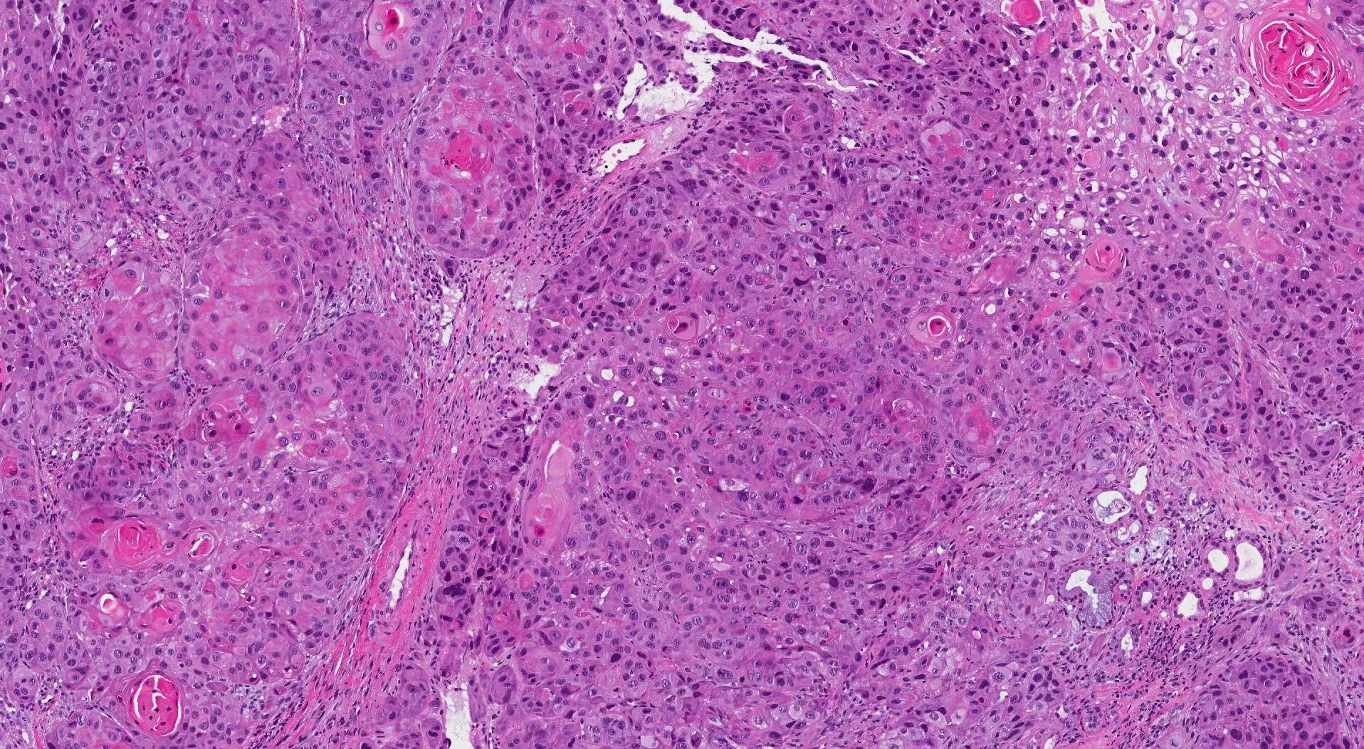 Плоскоклеточный рак горла фото Squamous cell carcinoma of the larynx MyPathologyReport.ca